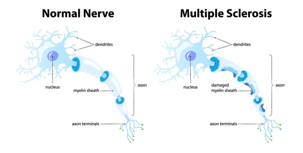 normaler Nerv vs. Multiple Sklerose