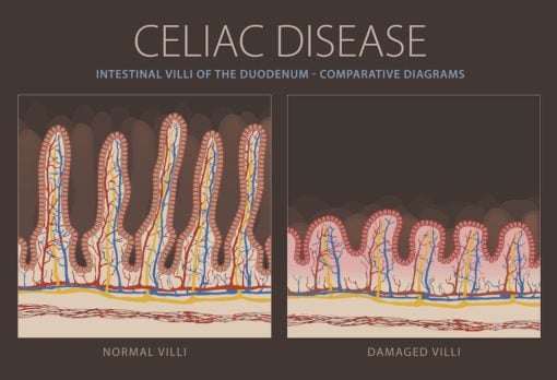 celiac disease can cause b6 deficiency